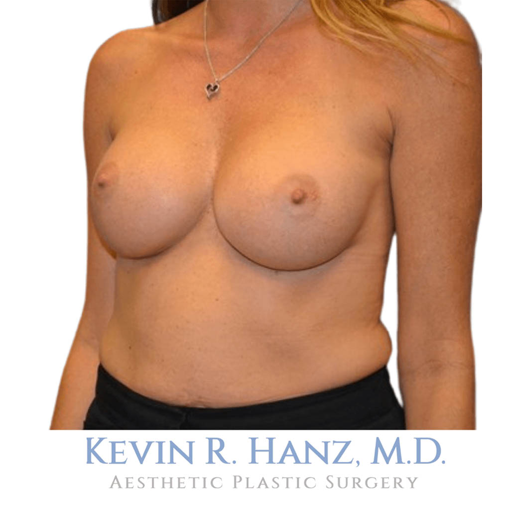 Case_65921_Breast_Aug_After_1 breast augmentation after photo