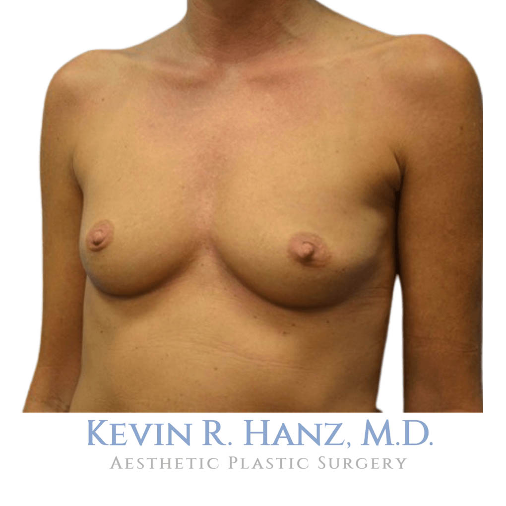 Case_65921_Breast_Aug_Before_1 breast augmentation before photo