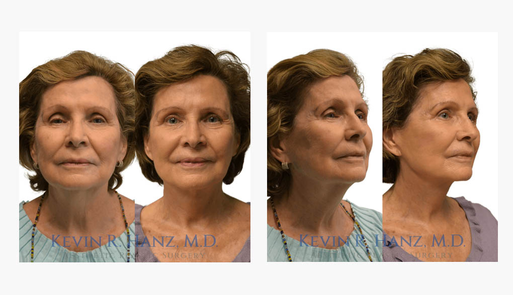 detailed face lift before and after photos