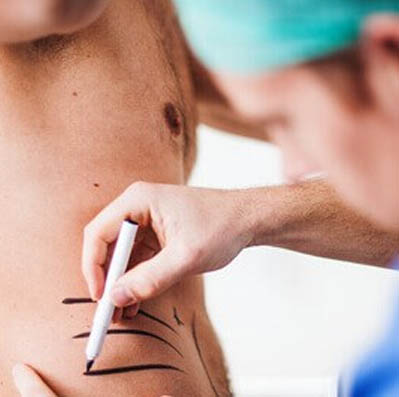 A doctor outlining a patient's waist before starting the liposuction surgery in Dallas, TX