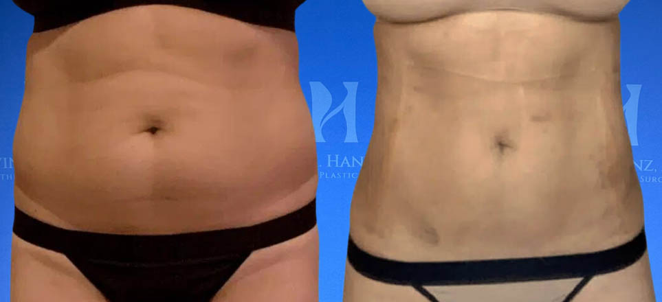 Lipo_Fat Transfer_62