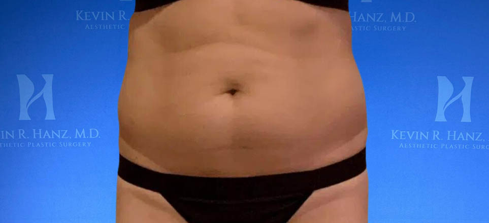 Lipo_Fat Transfer_63