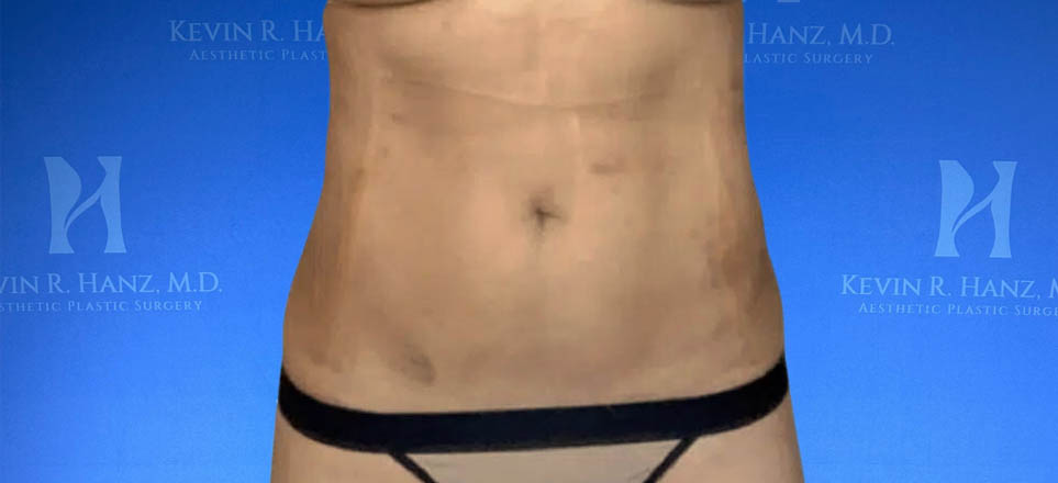 Lipo_Fat Transfer_64