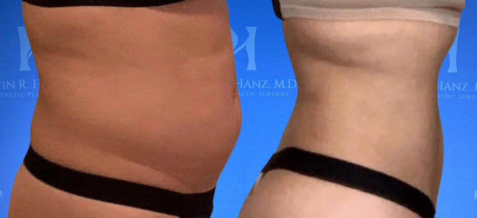 Lipo_Fat Transfer_65