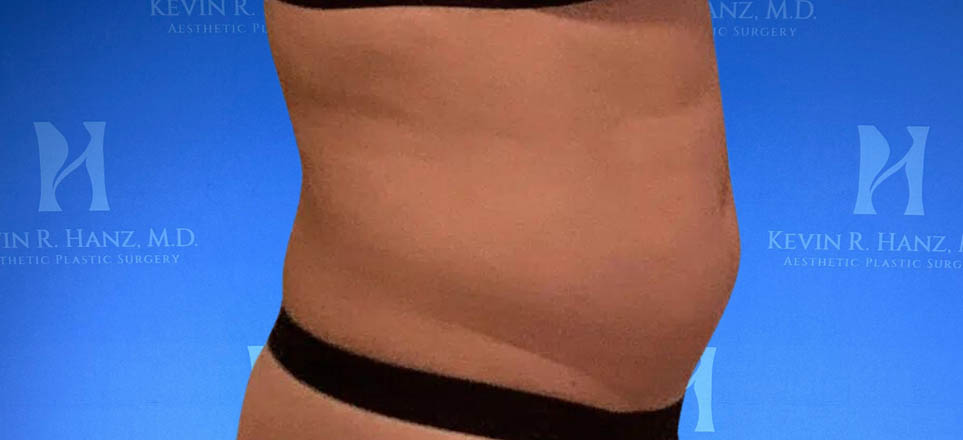 Lipo_Fat Transfer_66