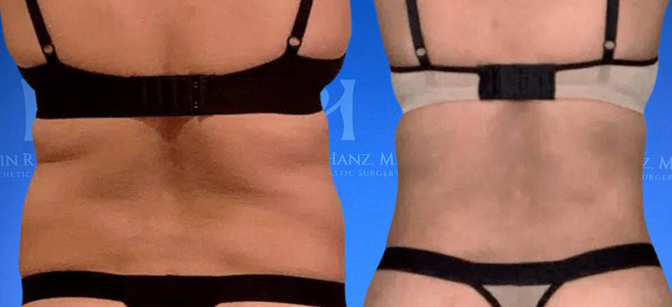 Lipo_Fat Transfer_68 A before and after image of a woman who underwent liposuction treatment in Dallas, TX.