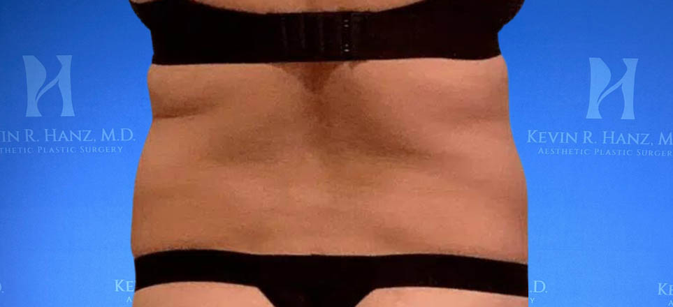 Lipo_Fat Transfer_69