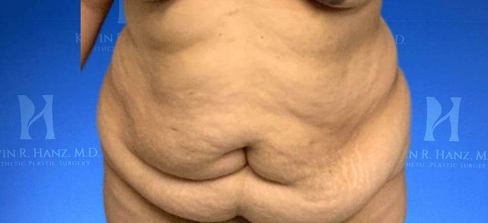 Lipo_Tummy Tuck_81