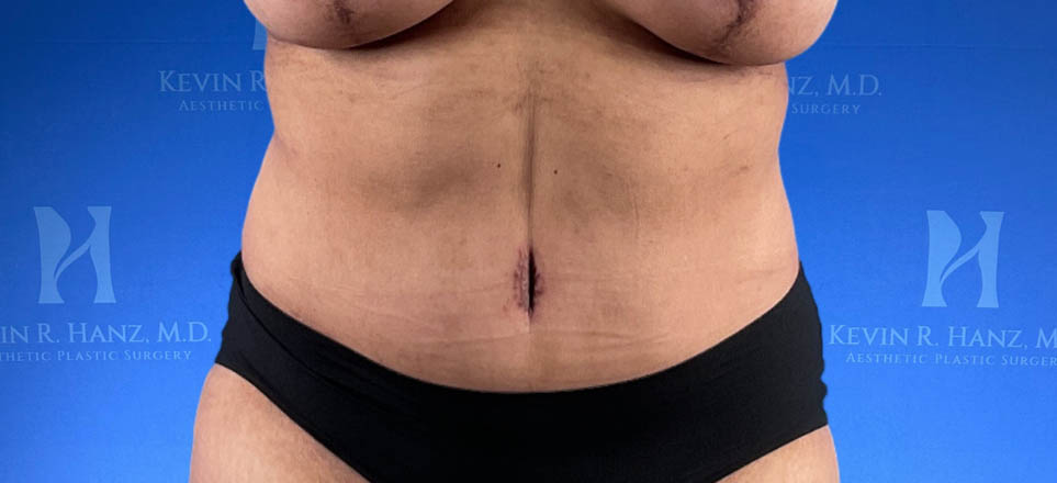 Lipo_Tummy Tuck_82 An afterimage of a woman who received tummy tuck treatment in Dallas, TX.