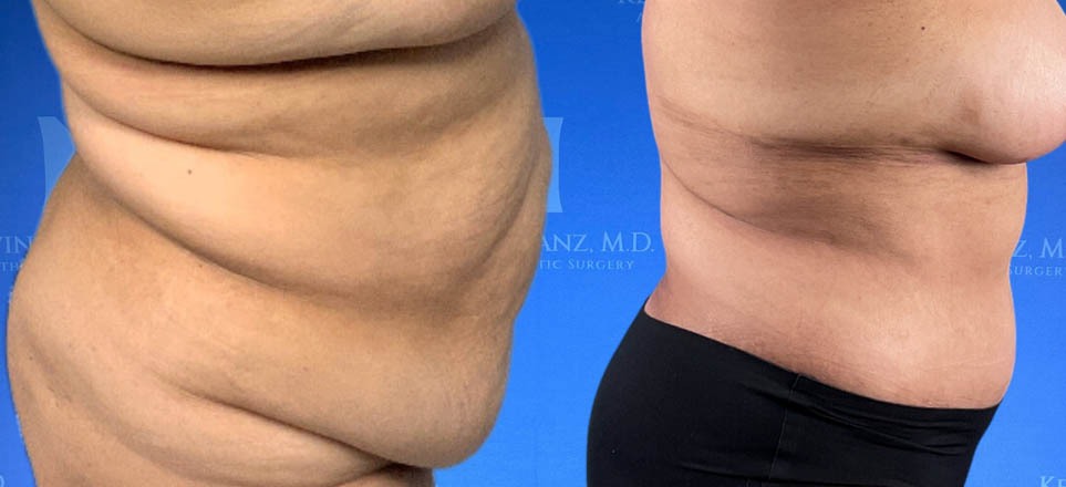 Lipo_Tummy Tuck_83