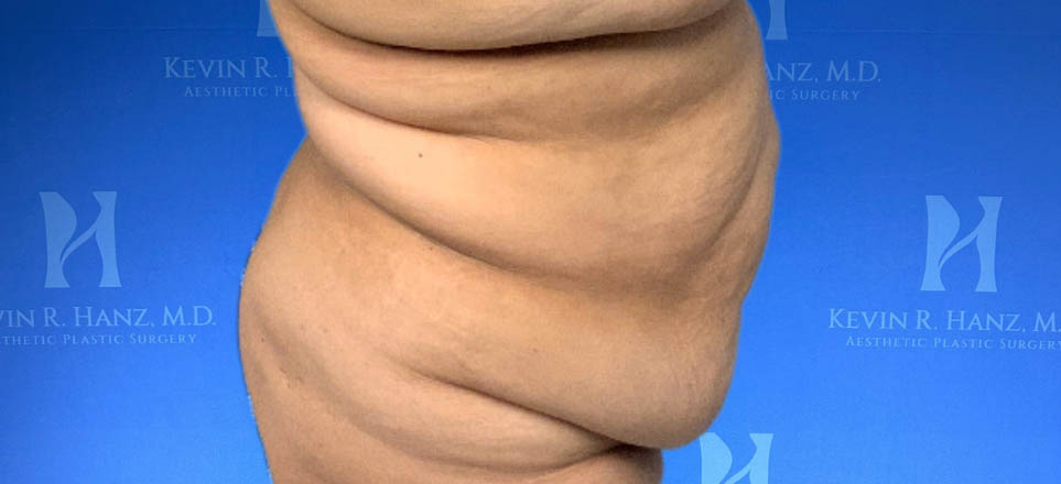 Lipo_Tummy Tuck_84