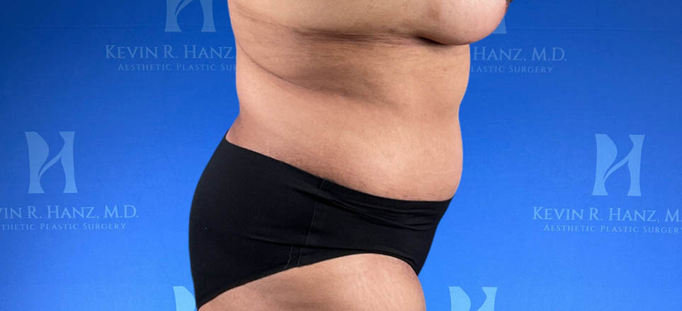 Lipo_Tummy Tuck_85