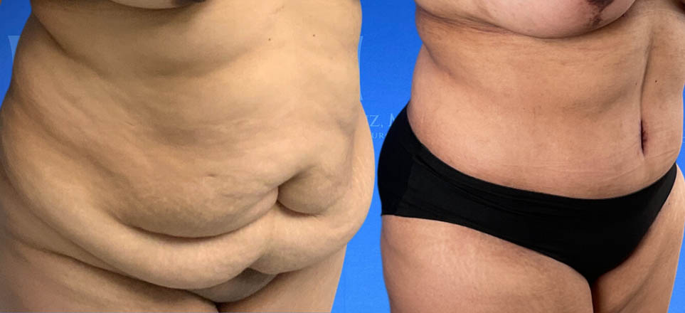 Lipo_Tummy Tuck_86 A before and after image of a woman who underwent tummy tuck treatment in Dallas, TX.