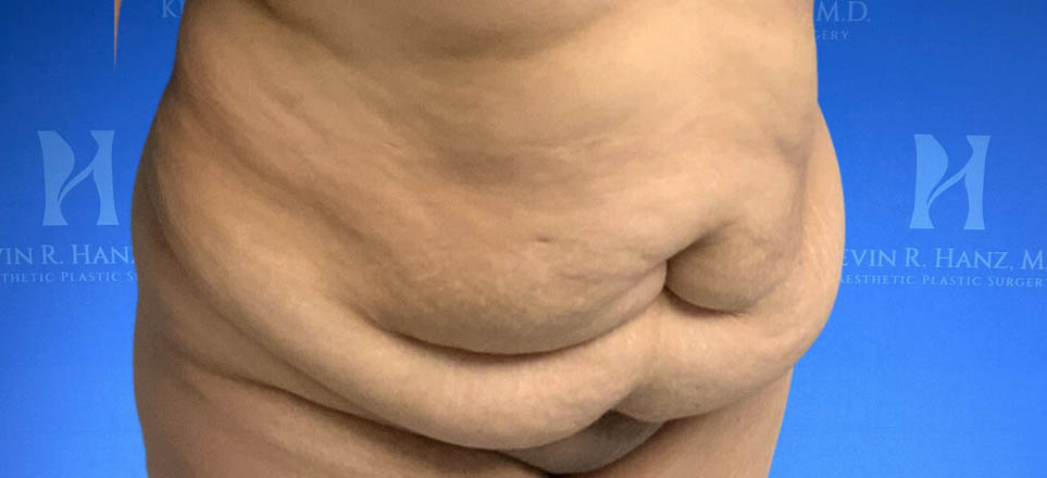 Lipo_Tummy Tuck_87 A before image of a woman who is about to receive tummy tuck treatment in Dallas, TX.