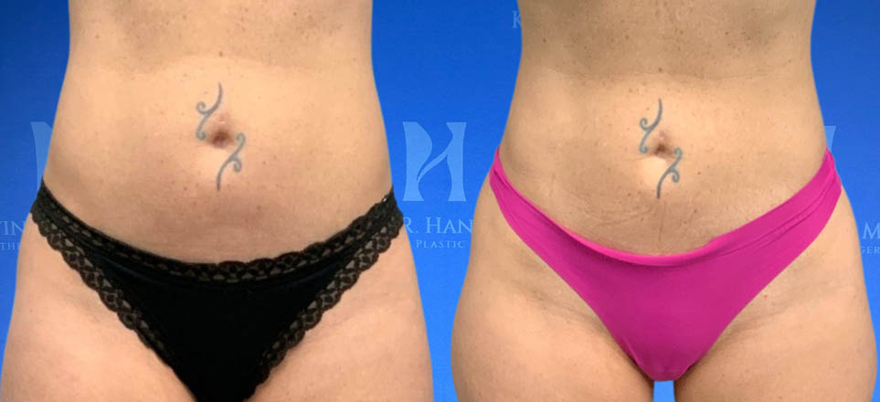 Liposuction View 100_1