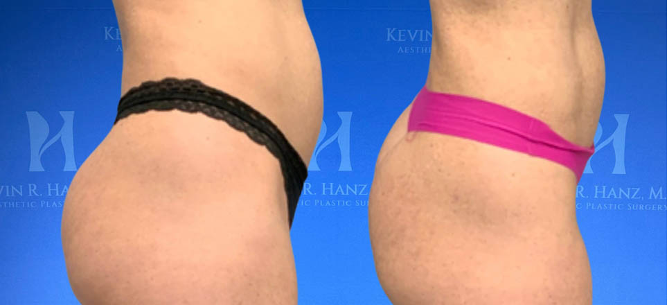 Liposuction_101 Liposuction View 100_2