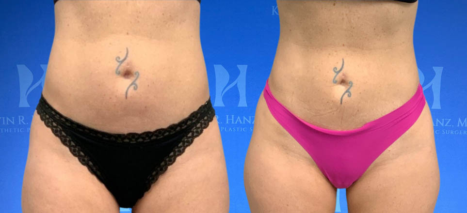 Liposuction_102 Liposuction View 100_3