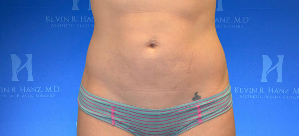 Liposuction_2 Liposuction View 1_2