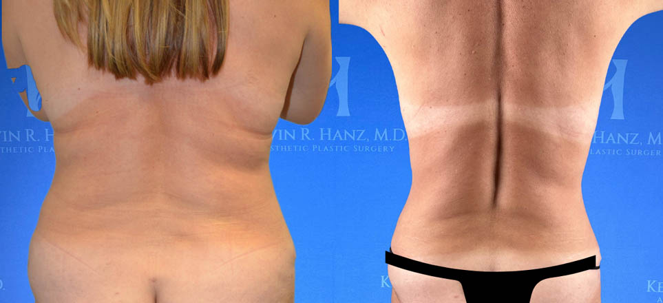 Liposuction View 28_1