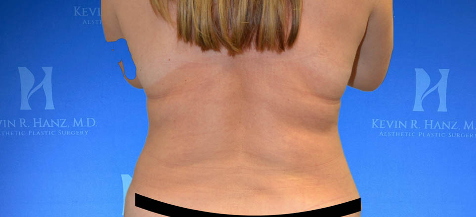 Liposuction View 28_2