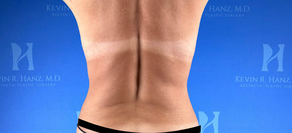 Liposuction View 28_3