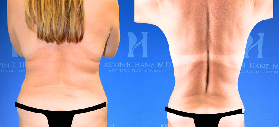 Liposuction View 28_4