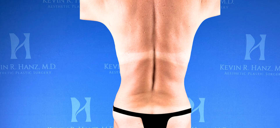 Liposuction View 28_6