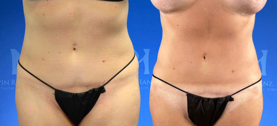 Liposuction View 28_8