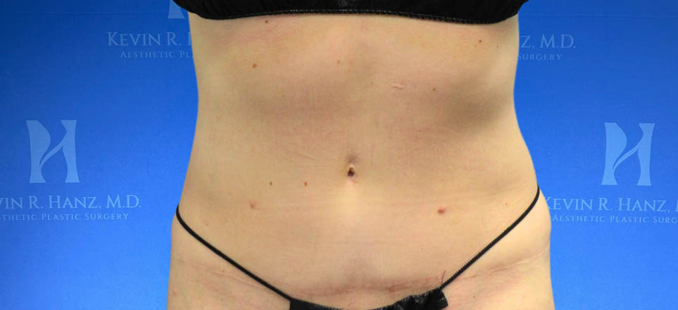 Liposuction View 28_9