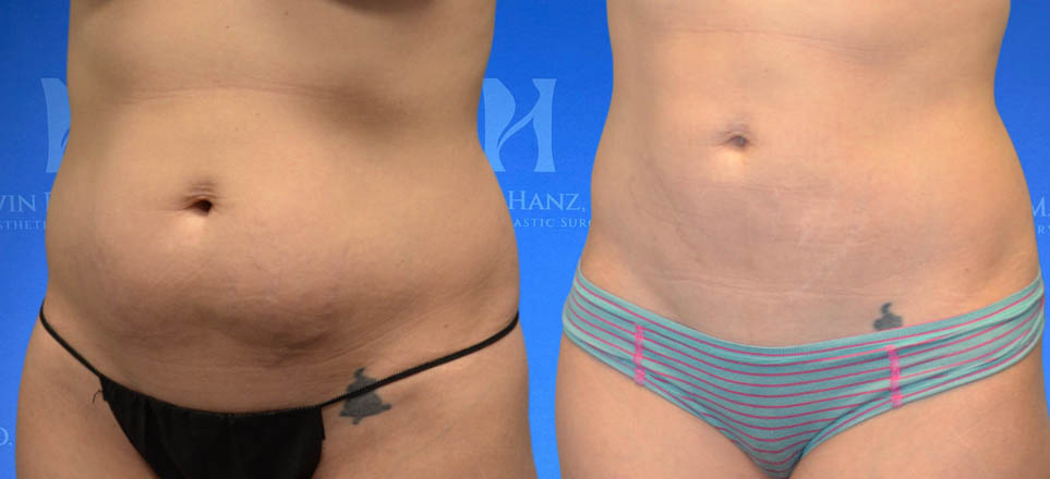Liposuction_4 Liposuction View 1_4
