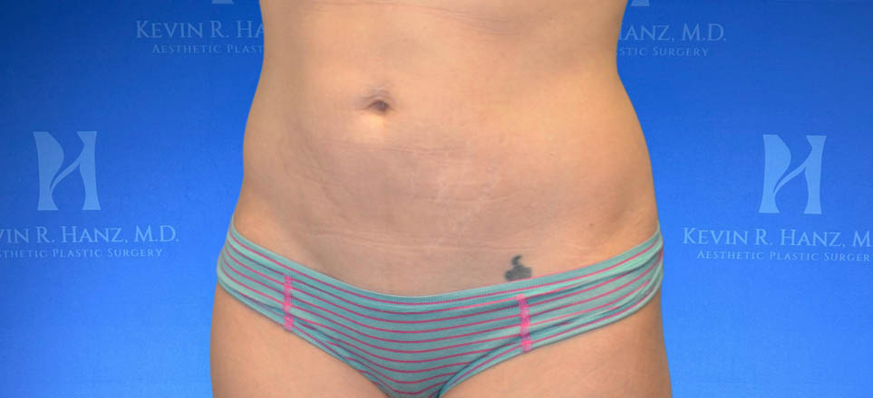 Liposuction_5 Liposuction View 1_5