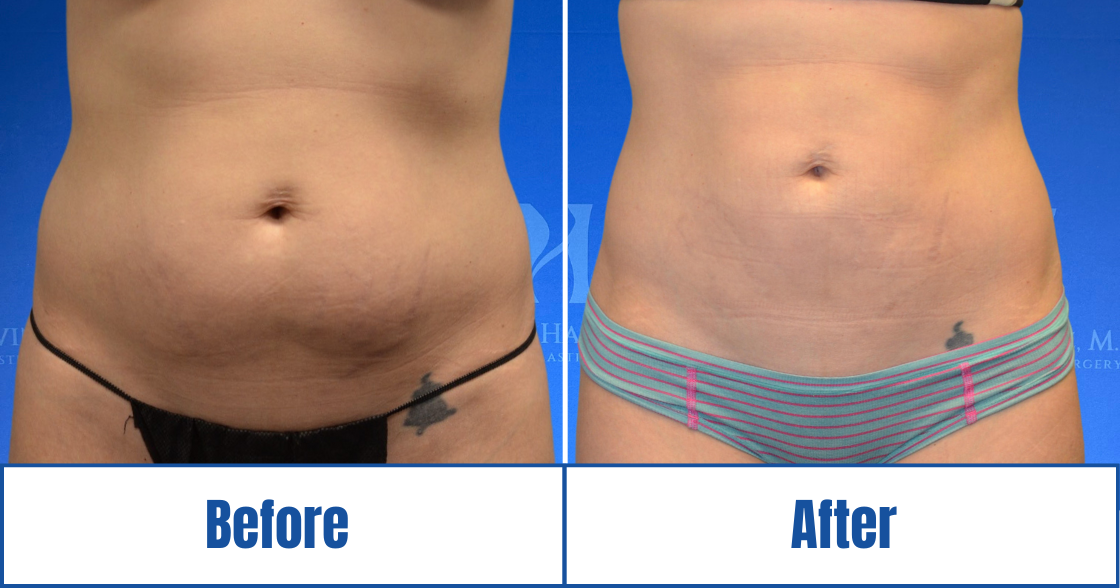 Liposuction View 1_1