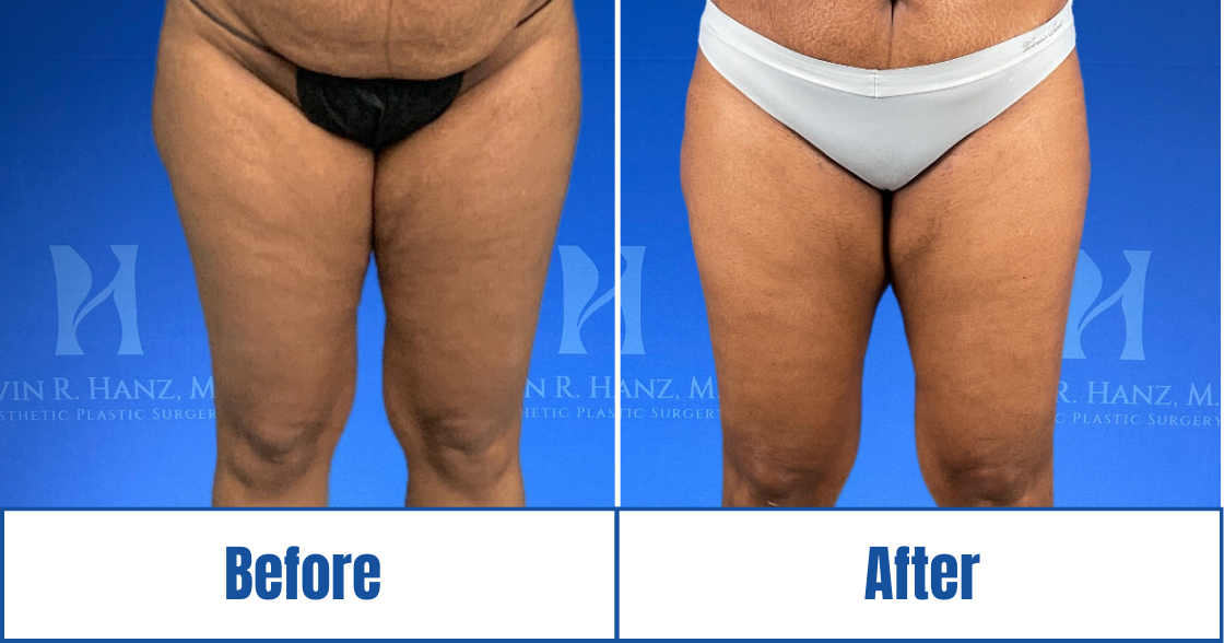 Liposuction View 100_2
