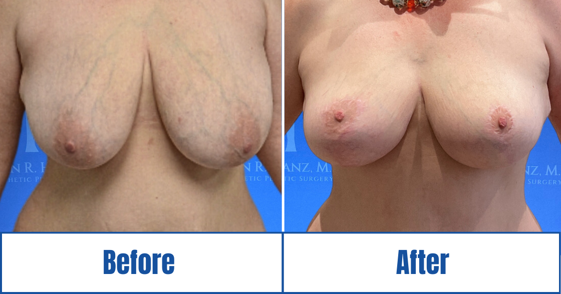 Breast Lift View 4