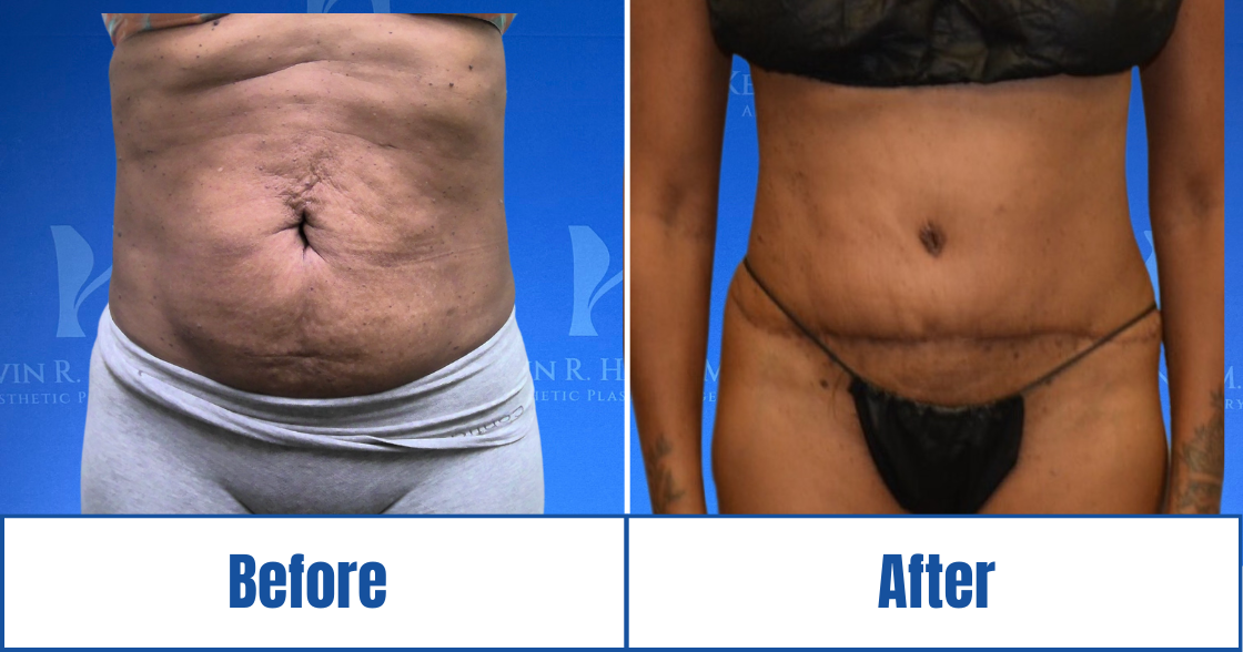 Abdominoplasty View 22_1