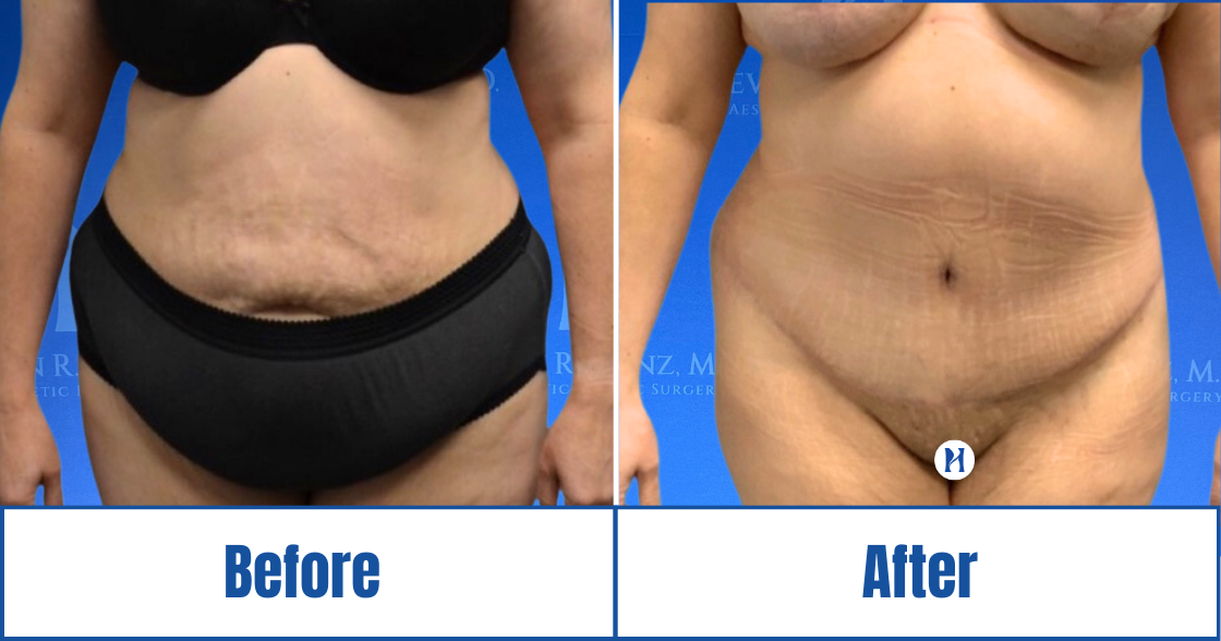 Abdominoplasty View 38_1