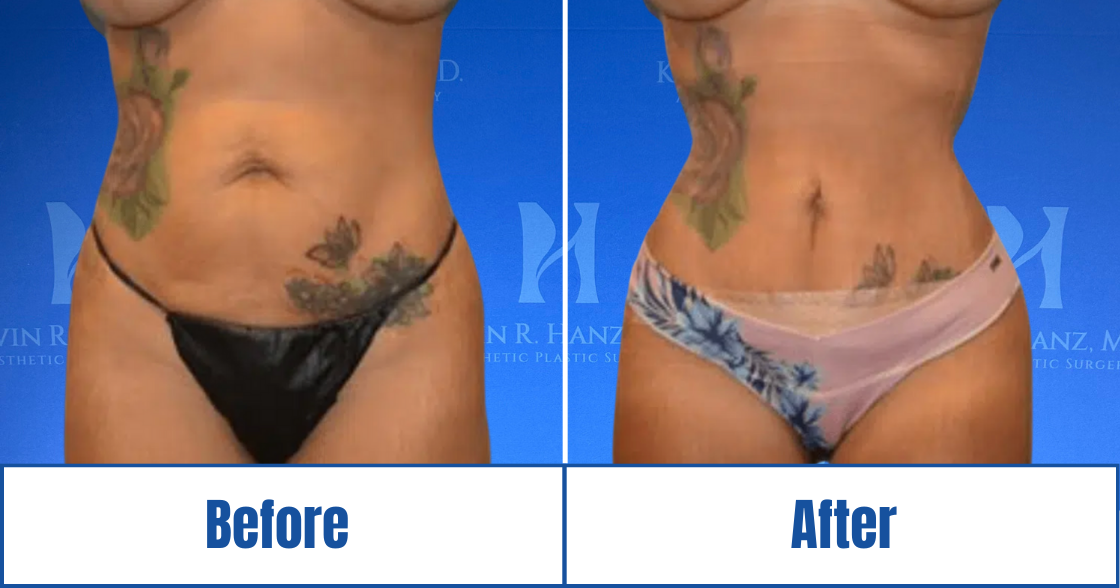 detailed face lift before and after photos