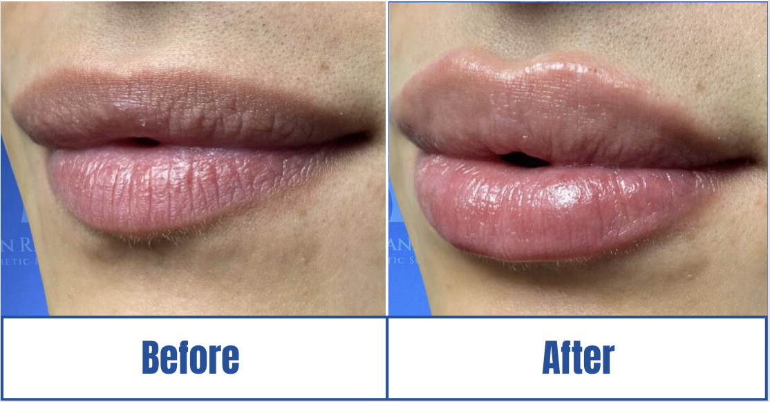 Lip Fillers View 1