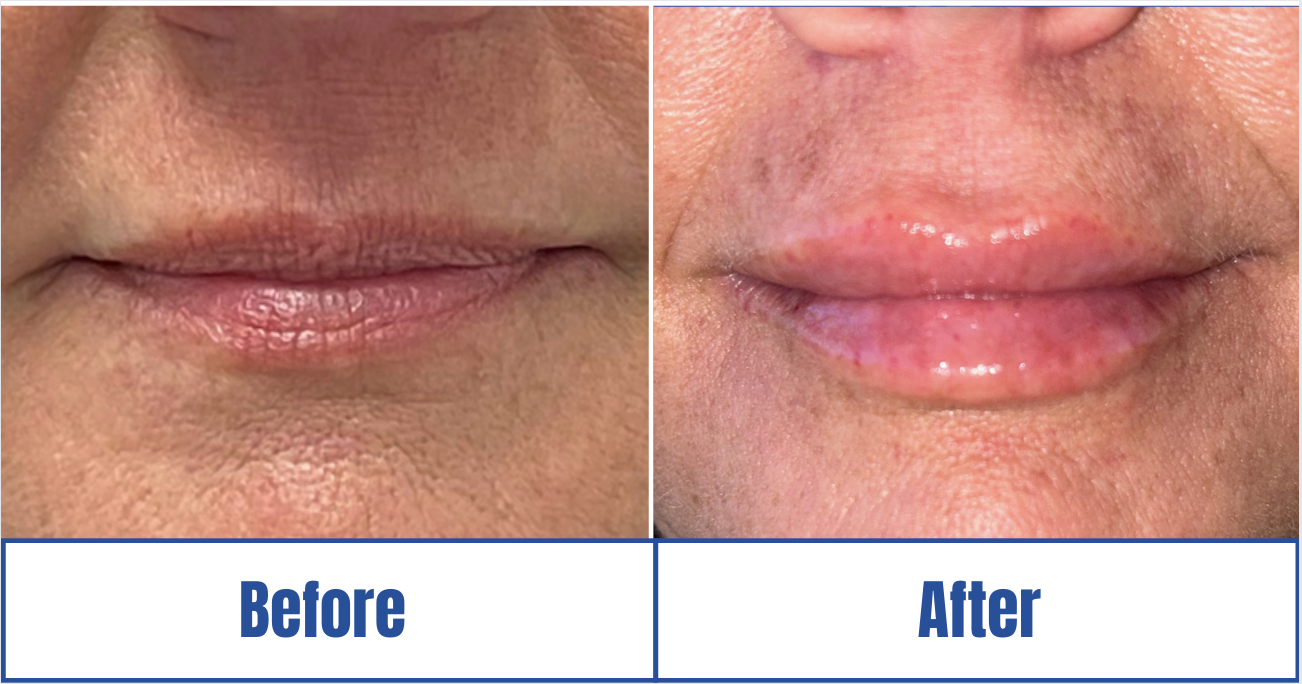 Lip Fillers View 1