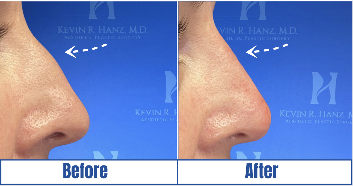 Lip Fillers View 1