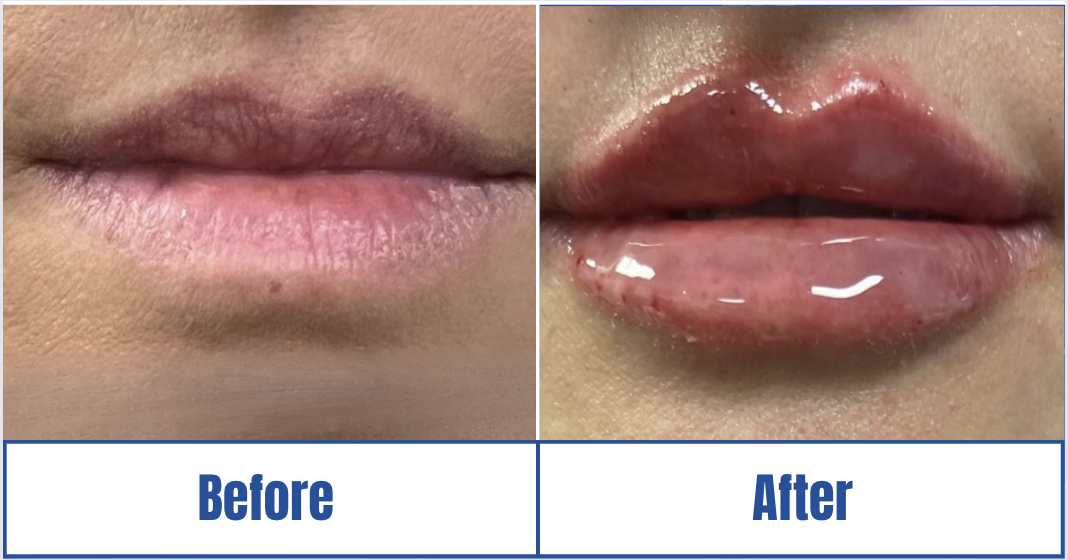 Lip Fillers View 1