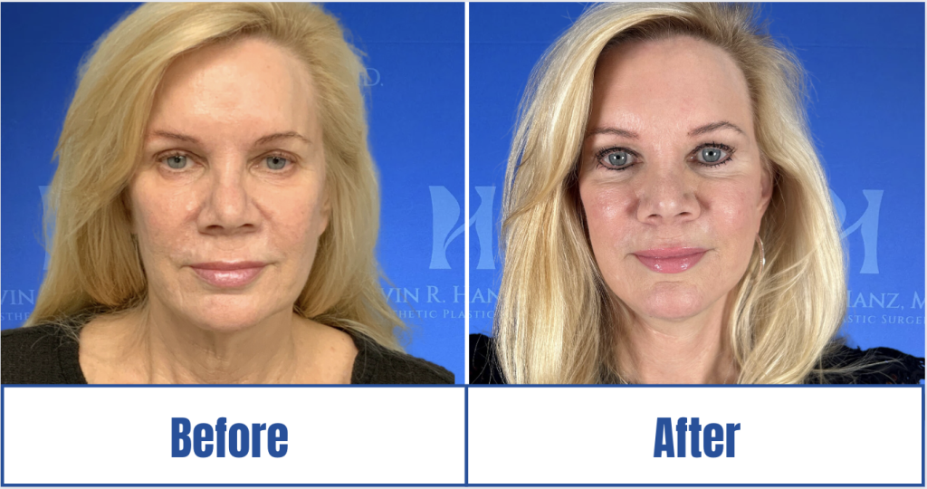 Screen Shot 2023-11-07 at 1.14.29 PM A before and after image of a woman who underwent facelift treatment in Dallas, TX.