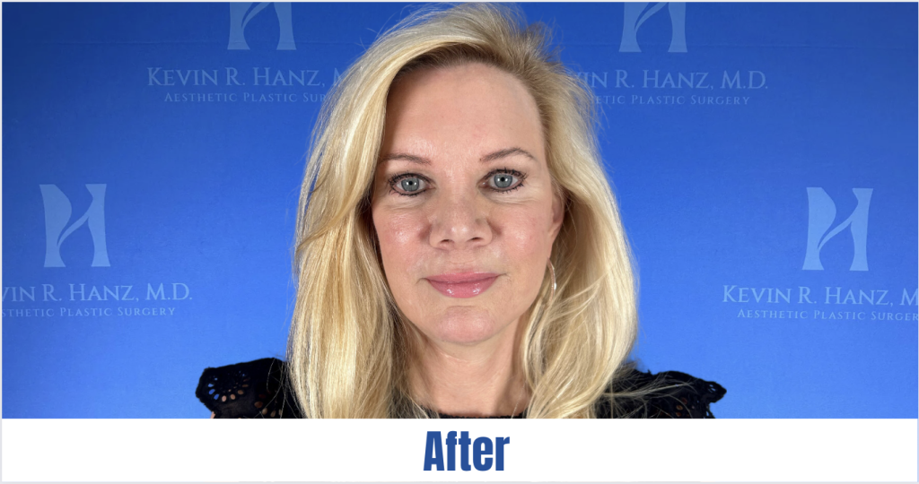 Screen Shot 2023-11-07 at 1.15.10 PM An afterimage of a woman received facelift treatment in Dallas, TX.