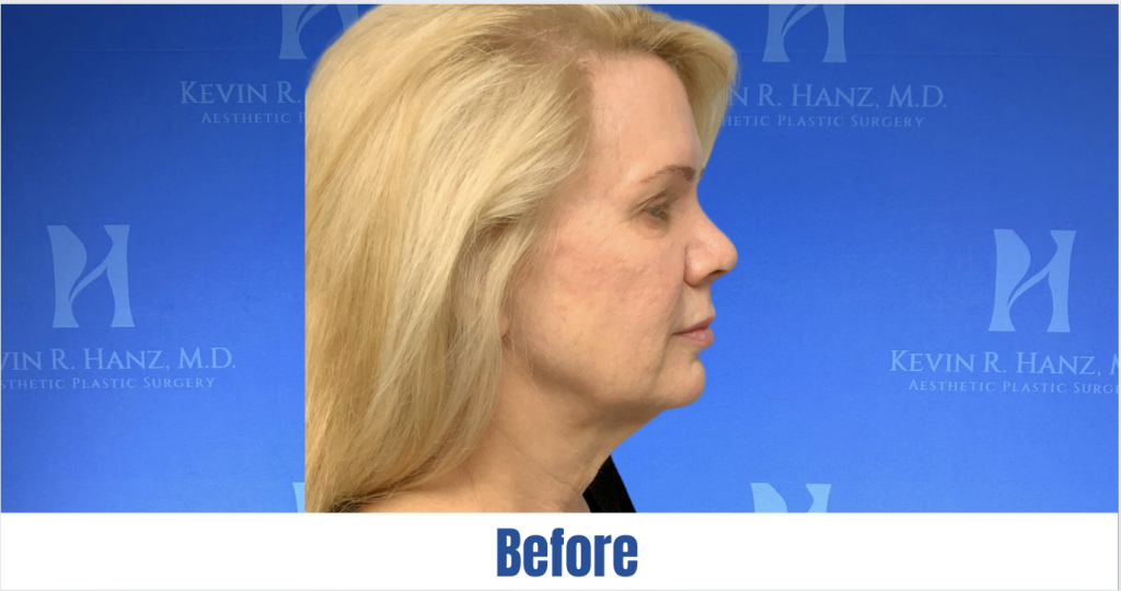 Screen Shot 2023-11-07 at 1.25.51 PM A before image of a woman is about to receive facelift treatment in Dallas, TX.