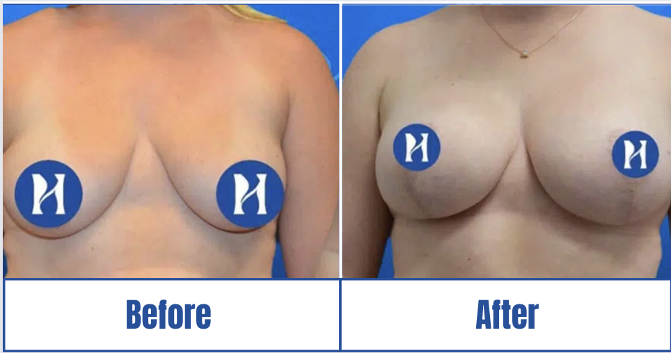Breast Augmentation View 1