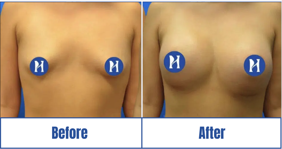 Breast Augmentation View 2