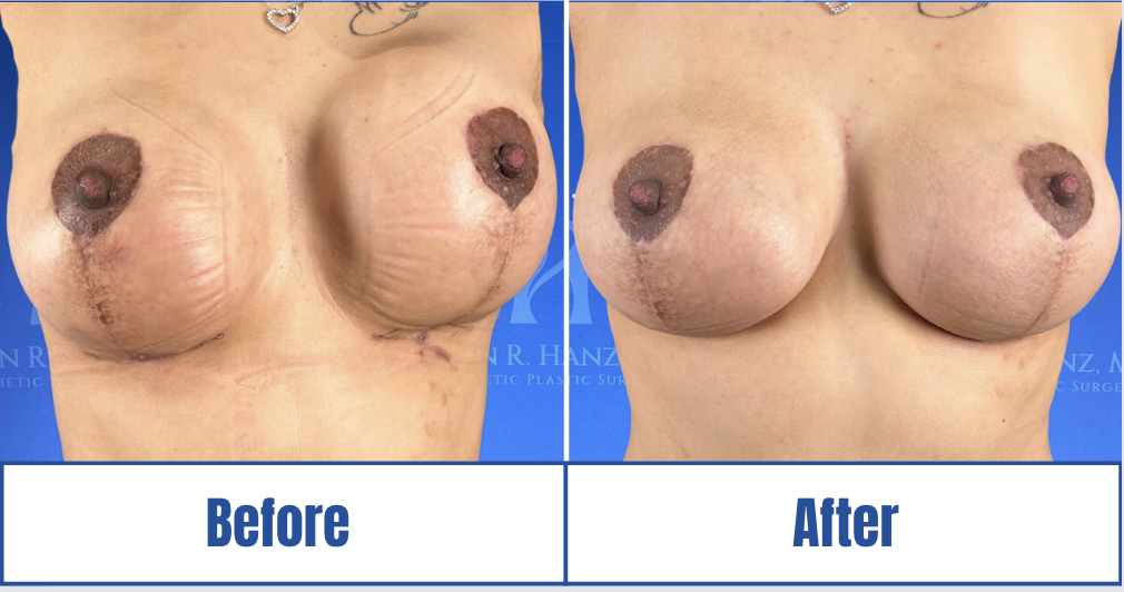 Breast Augmentation View 1