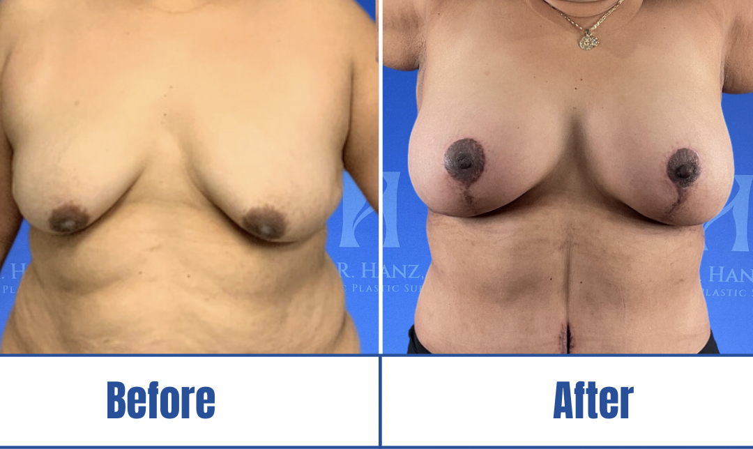 Breast Lift #2