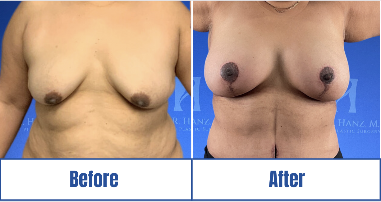 Mommy Makeover Image View 1