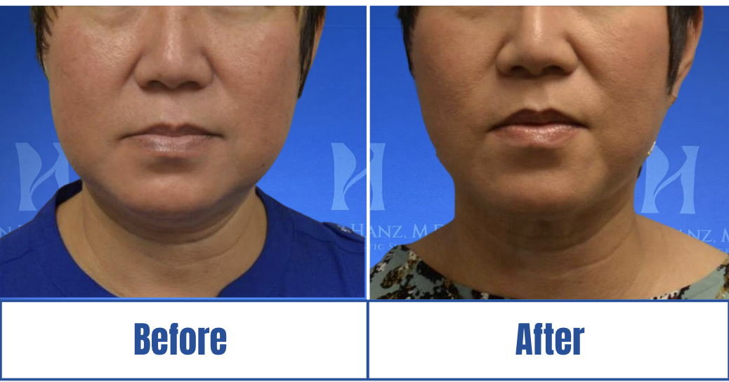 Liposuction View 28_8